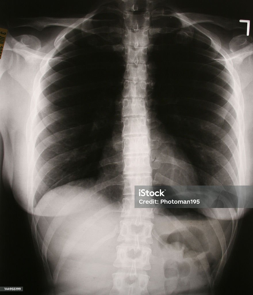 Рентгенография грудной клетки и позвоночник - Стоковые фото Thoracic Vertebrae роялти-фри