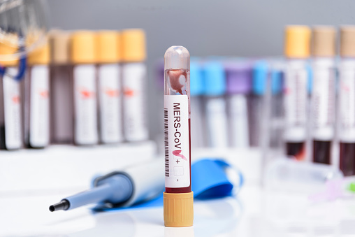 Close-up of laboratory sample positive for MERS-CoV infection