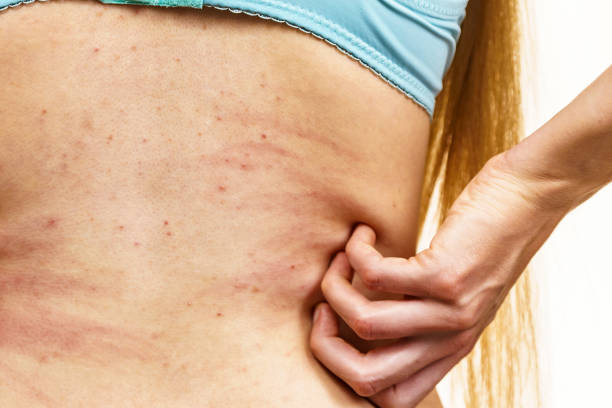 istock Woman scratching her itchy back with allergy rash 1449585361