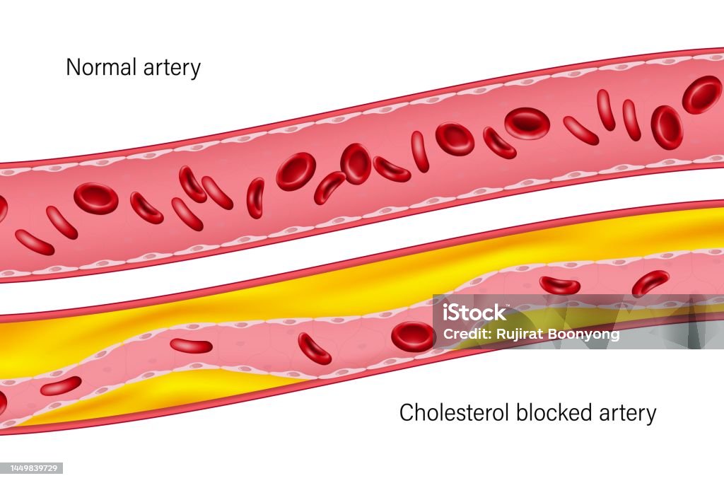 Normal Artery And Cholesterol Blocked Artery Clogged Arteries Caused By normal-artery-and-cholesterol-blocked-artery-clogged-arteries-caused-by