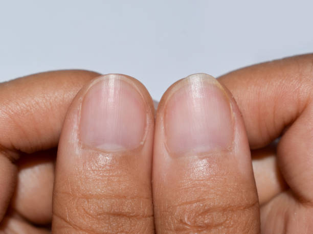 121 Horizontal Nail Ridges Stock Photos, Pictures & Royalty-Free Images - iStock 121 Horizontal Nail Ridges Stock Photos, Pictures & Royalty-Free Images - iStock