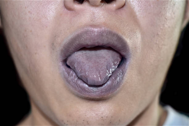 zyanotische lippen oder zentrale zyanose bei südostasiatischem jungen mann - discolored stock-fotos und bilder