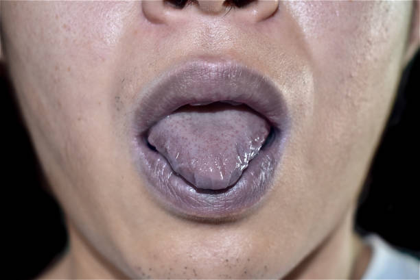 istock Cyanotic lips or central cyanosis at Southeast Asian young man 1449865733