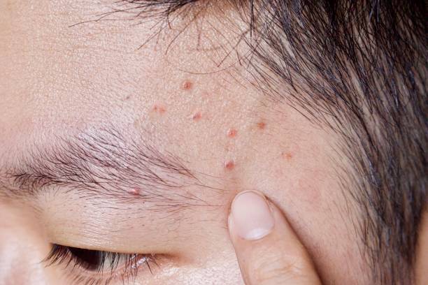 acne mechanica or sports-induced acne or whiteheads or mild acne at forehead - human face chinese ethnicity close up men imagens e fotografias de stock