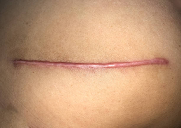 Neat, tidy and clean hypertrophic scar. Straight surgical incision. Neat, tidy and clean hypertrophic scar. Straight surgical incision. Top view. scar stock pictures, royalty-free photos & images