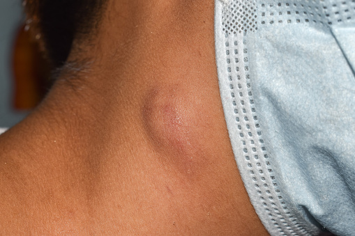 Single swelling or lymph node at the neck of Asian woman.