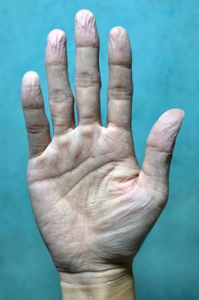 istock Pruney hand due to long soaking in the water. Hands skin shrinking. 1449869059