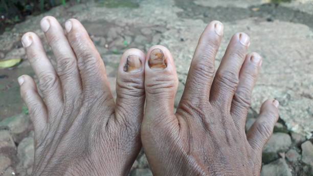 istock A woman's hand with brown skin color and mold 1450233845