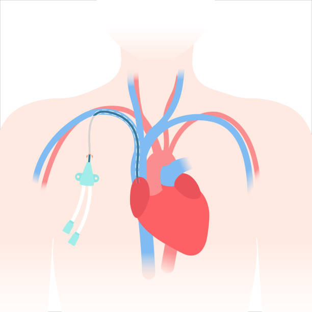 ilustraciones, imágenes clip art, dibujos animados e iconos de stock de diagrama médico del catéter venoso de la vía central tunelizada - surgery catheter cardiac catheterization hospital