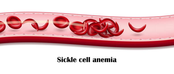 sichelzellenanämie. blutfluss der sichelzellenanämie. - sickle cell anemia red blood cell blood cell anemia stock-grafiken, -clipart, -cartoons und -symbole