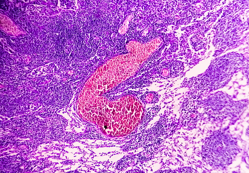 Photomicrograph of Stomach Adenocarcinoma. Gastric Adenocarcinoma.
