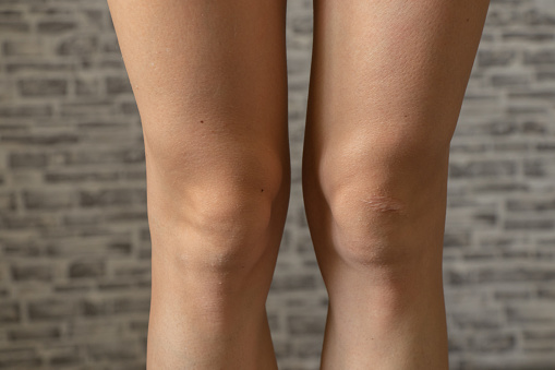 knees of a young white-skinned girl with a scar