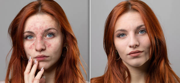 Before and after of a successful laser rosacea removal treatment Before and after a rosacea laser treatment. Successful removal of couperose from the face of a young woman. Red cheeks from inflamed capillaries of a Caucasian female. ugly face stock pictures, royalty-free photos & images
