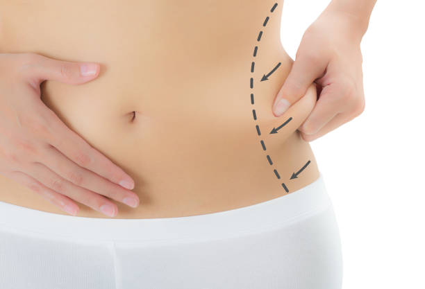 Close Up Woman Grabbing Skin On Her Flanks With The Drawing Black Arrows  Lose Weight And Liposuction Cellulite Removal Concept Isolated On White  Background Stock Photo - Download Image Now - iStock