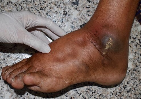 Pitting edema of lower limb. Swollen leg of Asian old man.