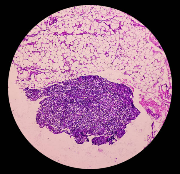 linfonodo (biópsia): linfoma de hodgkin, celularidade mista, população monótona de linfócitos, histiócitos, plasmócitos, grandes células mononucleares. doença de hodgkin. - non hodgkin lymphoma - fotografias e filmes do acervo