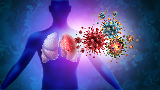 Triple Virus Lung Infection and Tripledemic Human lung infection and respiratory inflammation disease as influenza flu outbreak or pneumonia and pulmonary inflammatory illness with 3D illustration elements.