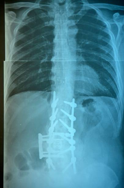 백 엑스레이 - orthopedic equipment osteoporosis x ray human spine 뉴스 사진 이미지