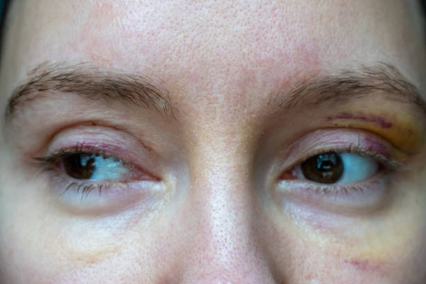 istock woman face recovery after plastic surgery, blepharoplasty operation, visible eyes wound cuts, swelling eye bags, swollen skin sutures and bruised eyelids. Healing process of creases 1451532521