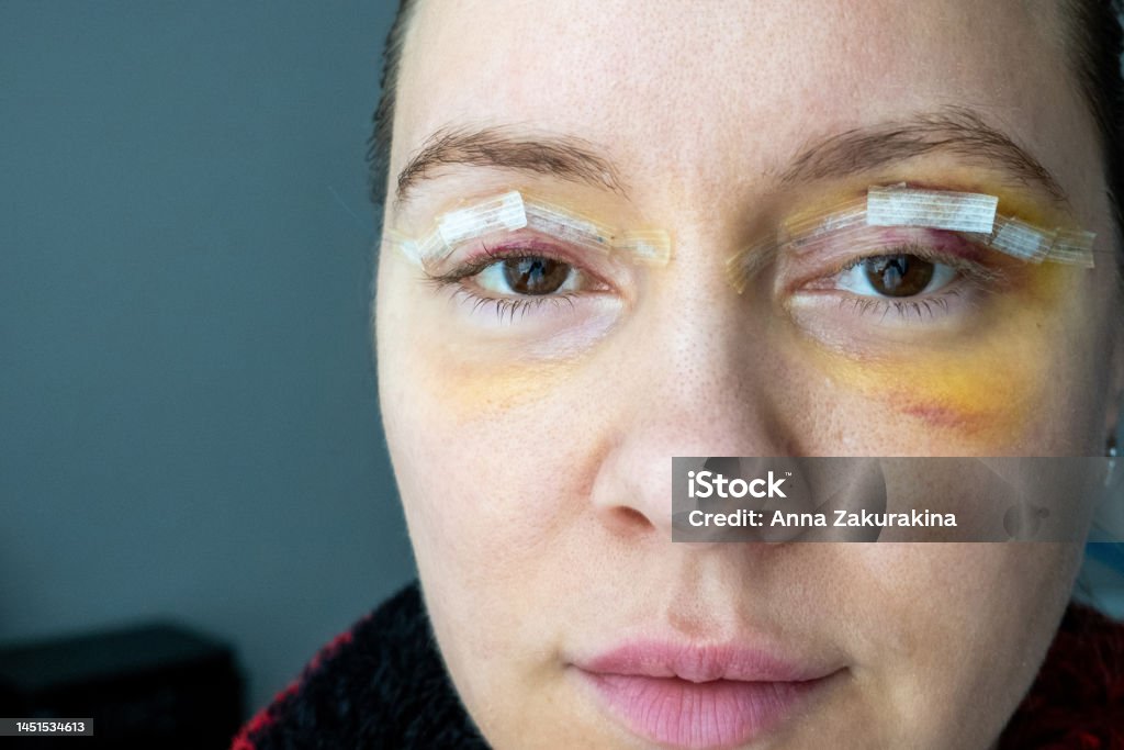 Woman Face After Plastic Surgery Yellow Skin Color Bruising woman-face-after-plastic-surgery-yellow-skin-color-bruising