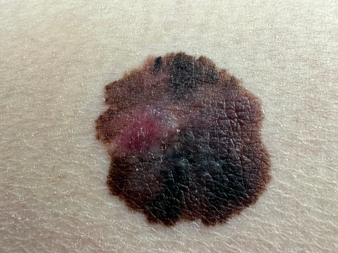 Skin cancer. Melanoma
