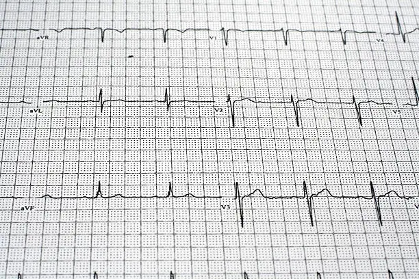 This is an image of an EKG printout.