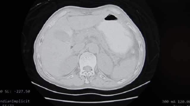 MRI Pleural and Abdominal Cavity Tomography