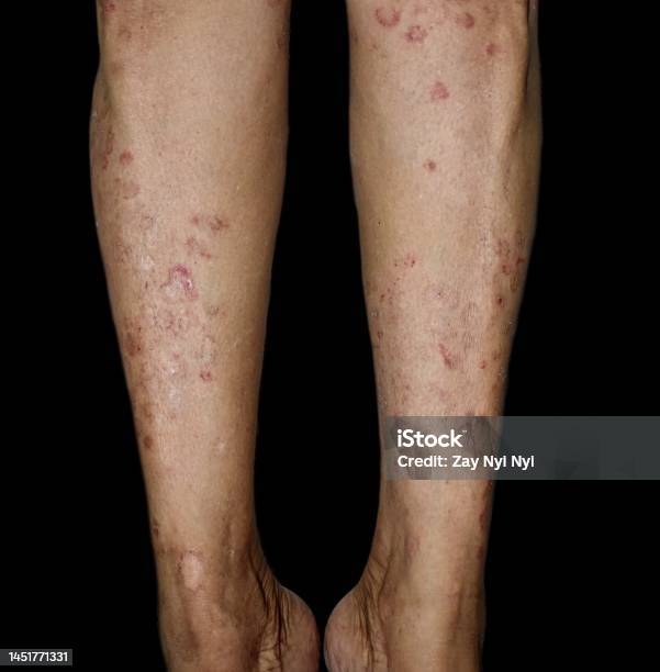 Fungal Infection Called Tinea Corporis In Leg Of Asian Woman - Fotografias  de stock e mais imagens de Perna - iStock