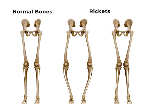 Rickets is a metabolic disease characterized by deformities of the bones. The most common symptoms are bowed legs. 3D illustration