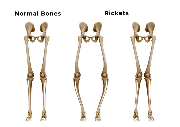 Rickets is a metabolic disease characterized by deformities of the bones. The most common symptoms are bowed legs stock photo