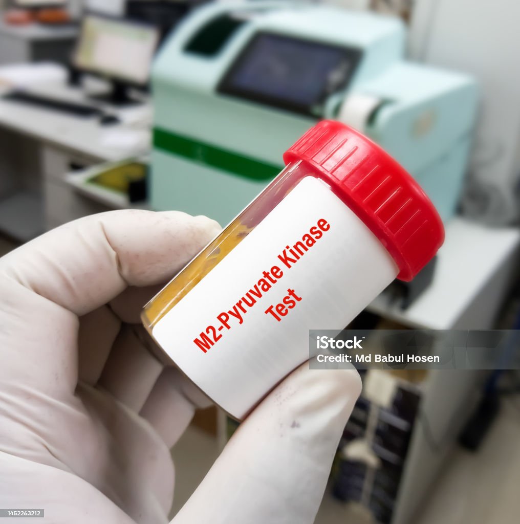 Stool sample for M2-pyruvate kinase(M2-PK) Test, is a non-invasive stool test. Stool sample for M2-pyruvate kinase(M2-PK) Test, is a non-invasive stool test, used to early detection of colorectal cancers and polyps, precursors of colorectal cancer. Analyzing Stock Photo