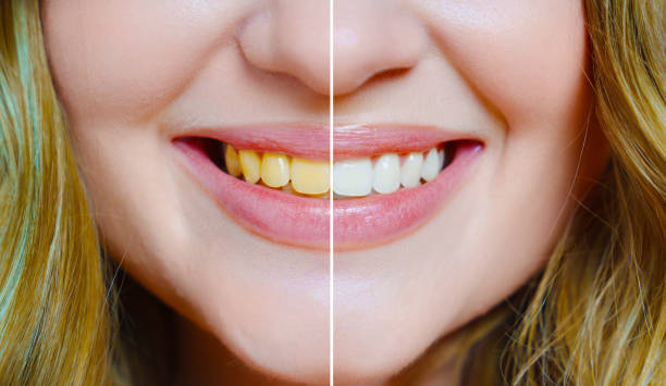 istock close-up. a woman's smile with a comparison of whitened and yellow teeth. 1452304244
