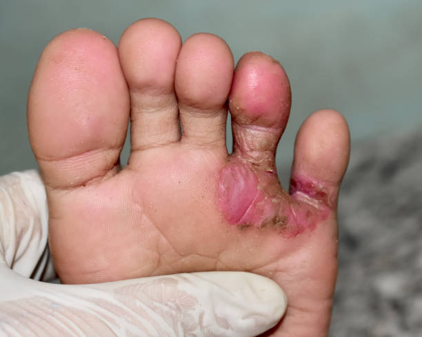 fungal infection called tinea pedis at the foot - frieiras imagens e fotografias de stock