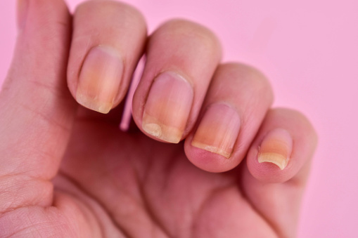 Damaged and yellowed nails of a woman on a blue background.Copy space.