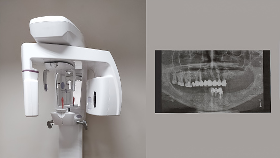 Modern dental digital 3D tomograph. Dental cone beam tomograph, treatment and prevention of oral cavity