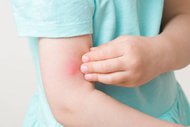 Toddler girl fingers itching red bite of mosquito on arm skin. Closeup. stock photo