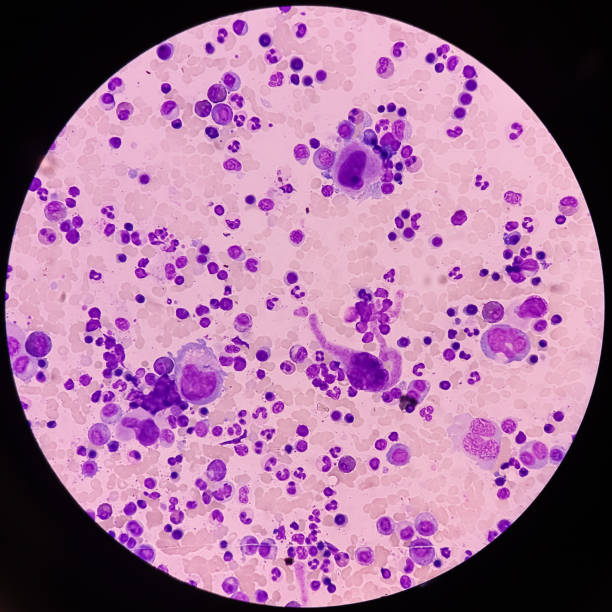 istock Bone marrow study, microscopically show megakaryocytes. Megakaryocytic hyperplasia. 1452828496