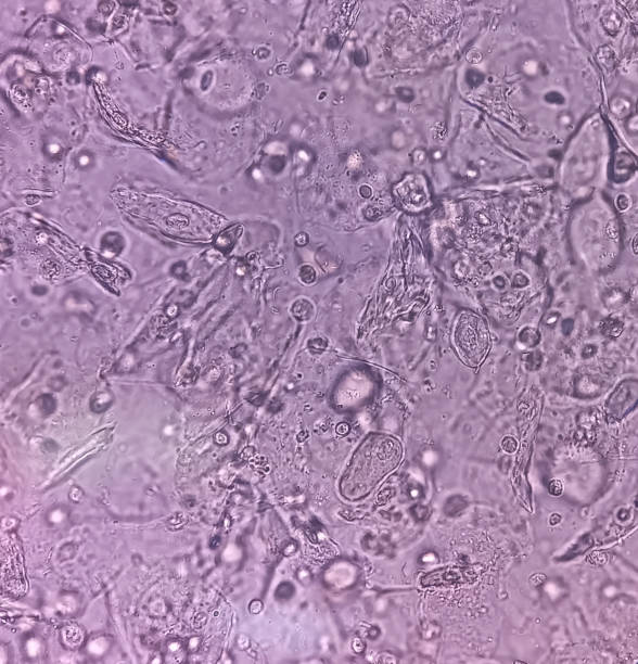 Urine Microscopic Rbc 100+ Red Blood Cell Urinalysis Stock Photos, Pictures & Royalty-Free ...