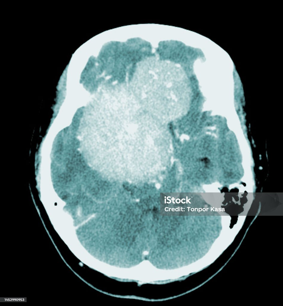 Ct Brain Axial Quét Khối Lượng Hyperdense Với Phù Não Đồng Nhất Và ...
