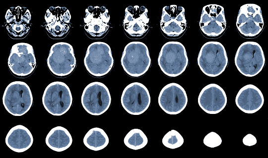 Ct Brain Collimation Ct Brain Axial Scan Hyperdense Massa Dengan Homogen Dan Edema Otak ...