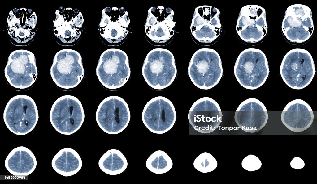 Ct Brain Collimation Ct Brain Axial Scan Hyperdense Massa Dengan Homogen Dan Edema Otak ...