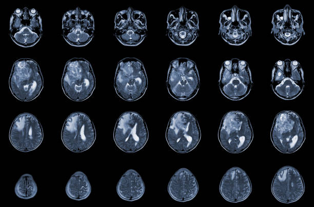 mri brain axial views .to evaluar el tumor cerebral. glioblastoma, masa de isodensidad de metástasis cerebral con un margen mal definido y edema circundante en el lóbulo frontal derecho. - laboratory healthcare and medicine cancer drug histology fotografías e imágenes de stock