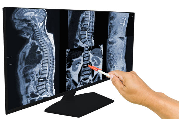 the doctor reported the mri scans of the lumbar spine compression fracture bulging of l1-l2. and post operation fixed by iron rod and screws. medical education concept. - sakrum fotoğraflar stok fotoğraflar ve resimler