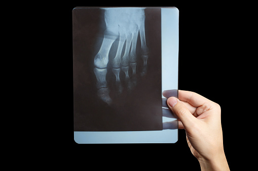 Hand holding x-ray of foot, isolated on black background