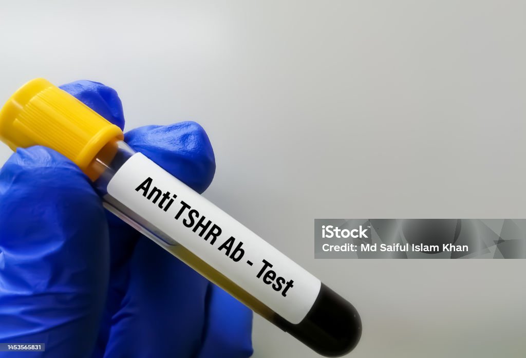 Tsi Lab Thyroid Stimulating Immunoglobulin Test Thyrotropin Binding Inhibitory ...