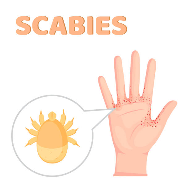 Sarcoptes scabiei. scabies. Sexually transmitted disease. Infographics. illustration on isolated background. Scabies. contagious skin infestation. scabies mite and Human skin with Magnified view of a burrowing trail of the mite. sarcoptes scabiei stock illustrations