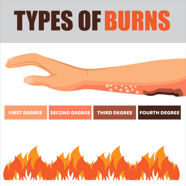 Skin burn injury treatment and stages infographic. damage from fire. Red skin. Isolated vector illustration in cartoon style Skin burn. Burned hand, stages of burning. Flat vector medical treat illustration. Degree burning burnout skin hand, damage and medical care cartoon of a burn victim stock illustrations