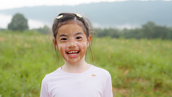 Little cute alpha young albino vitiligo small school girl relax smile look at camera. Real melanin face body skin care hair color of asia people gen z kid in self love happy proud of diverse beauty.