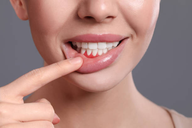 young woman showing inflamed gums on grey background, closeup - gums imagens e fotografias de stock