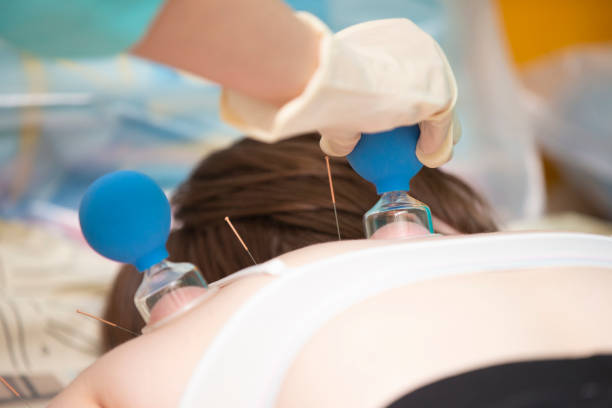 the doctor makes the patient acupuncture and vacuum massage. - acupuncturist imagens e fotografias de stock